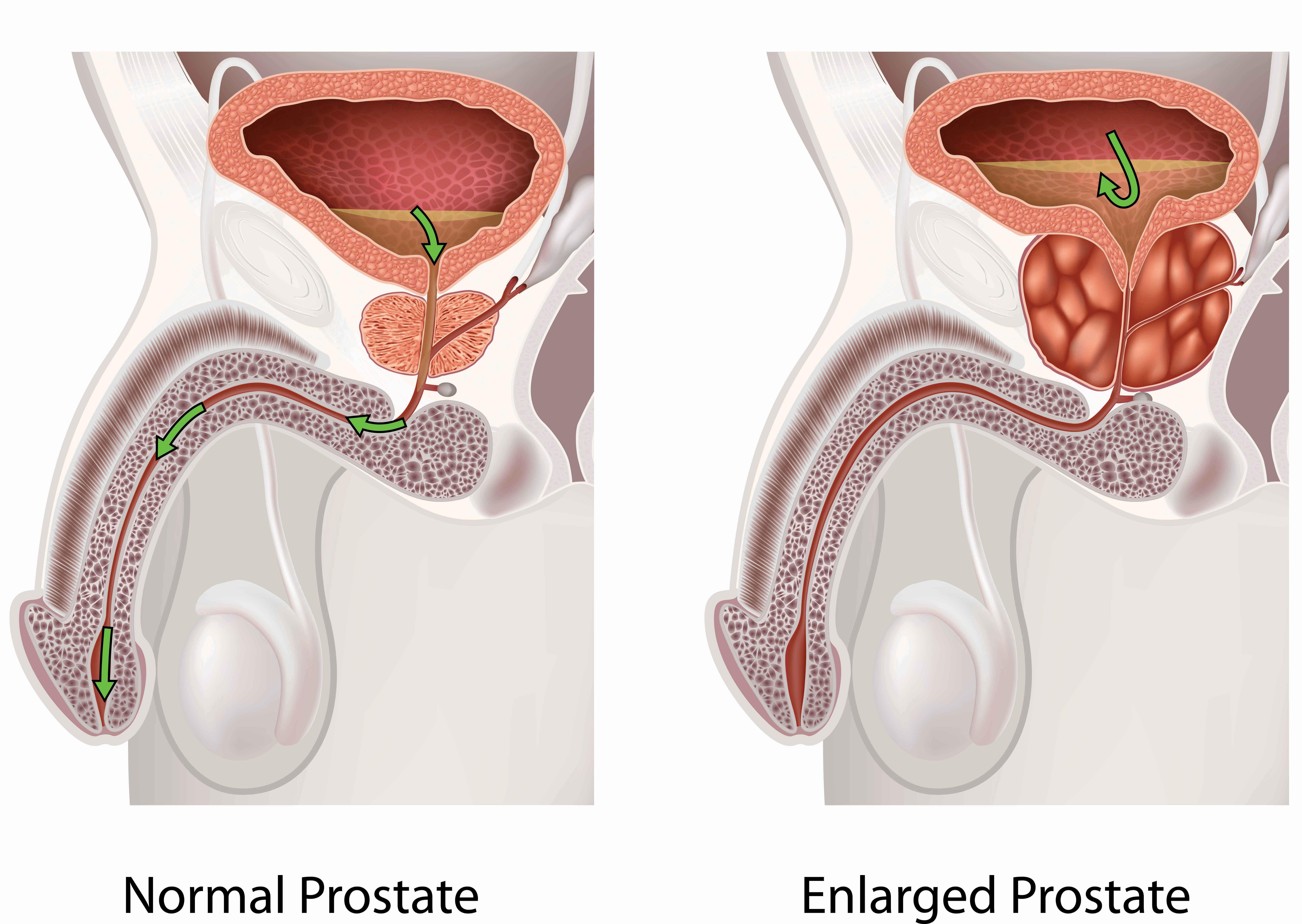 clonidine benign prostatic hyperplasia