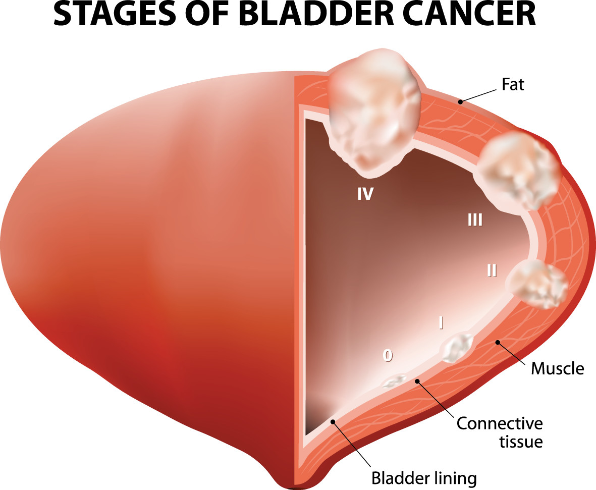 bladder cancer 