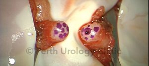 Microscopic Vasectomy Reversal-How big is a micron? - Georgia